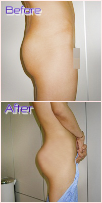 buttock augmentation, buttocks implants in thailand