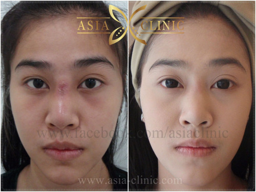 scar removal before after