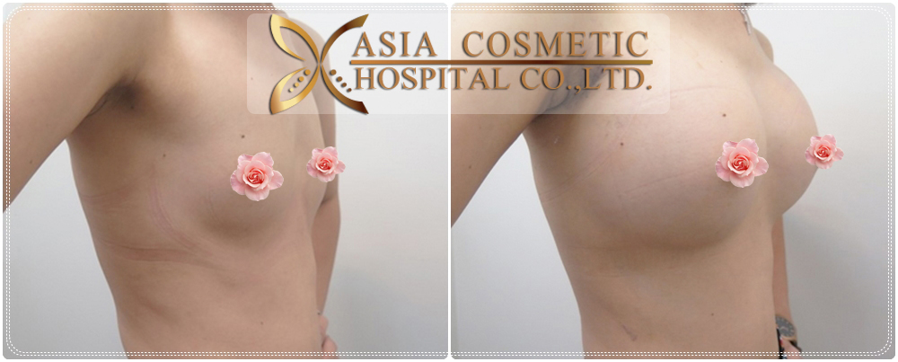 Asian Breast Enlargement 49
