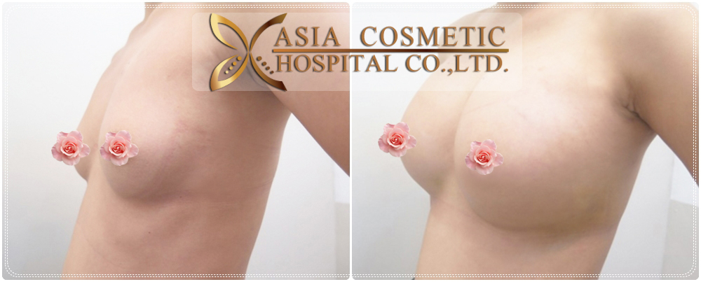 After Effects Of Breast Augmentation 98