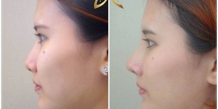 The Method for Nose Augmentation Nowadays