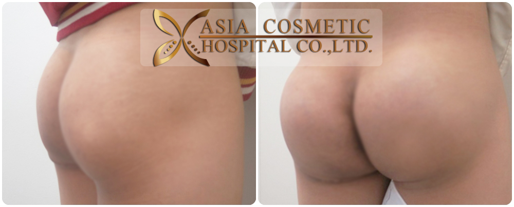 Buttocks Implants Before After