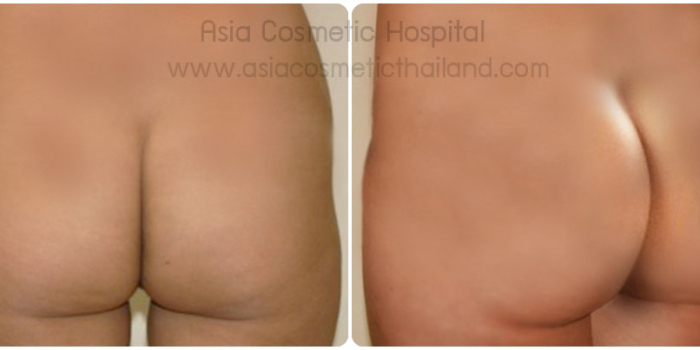 Buttocks Implants Before/After Photos and Costs