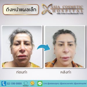Face Lift Surgery