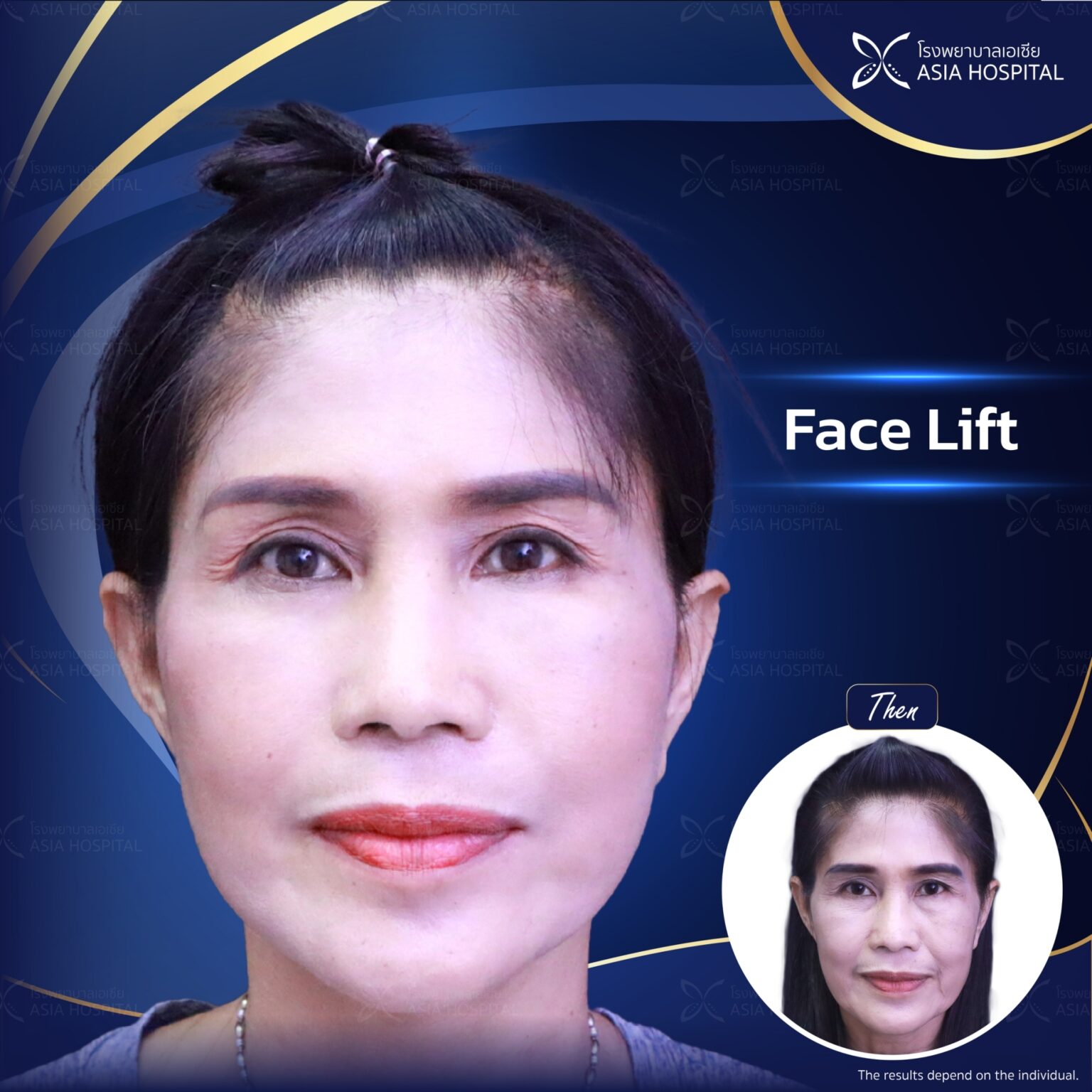 Face lift