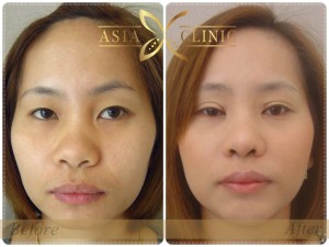 eyelid surgery