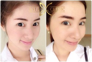 eyelid surgery thailand