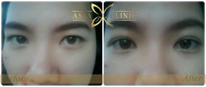 eyelid surgery upper