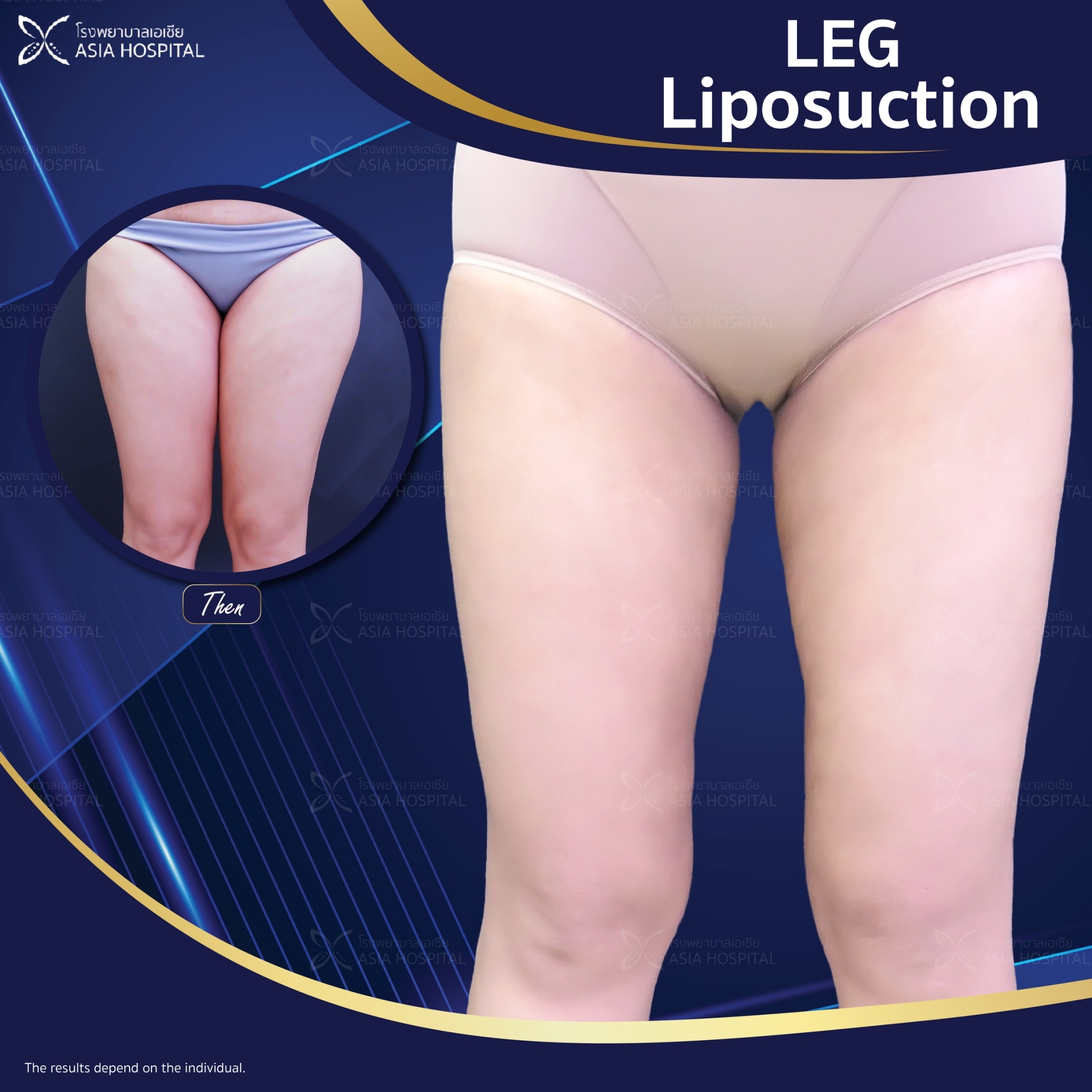 liposuction-thailand