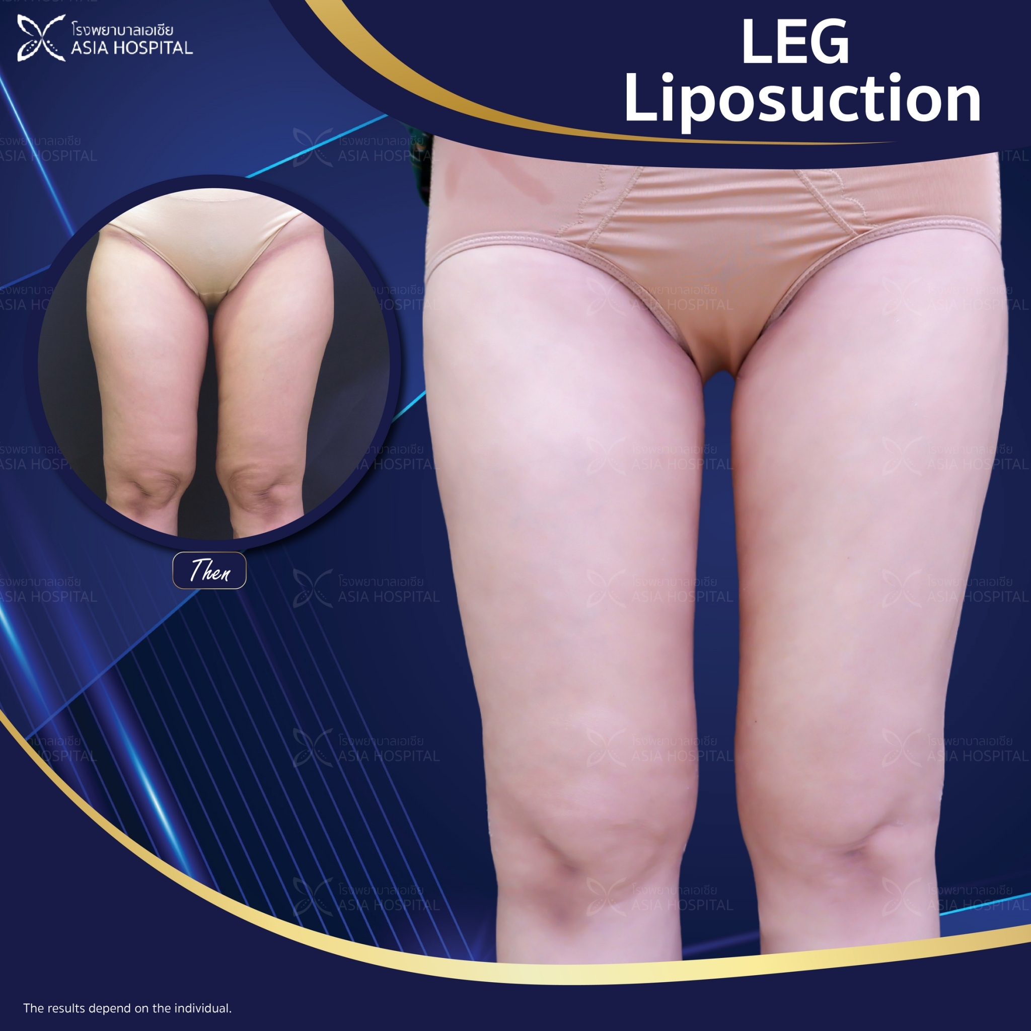 liposuction-thailand