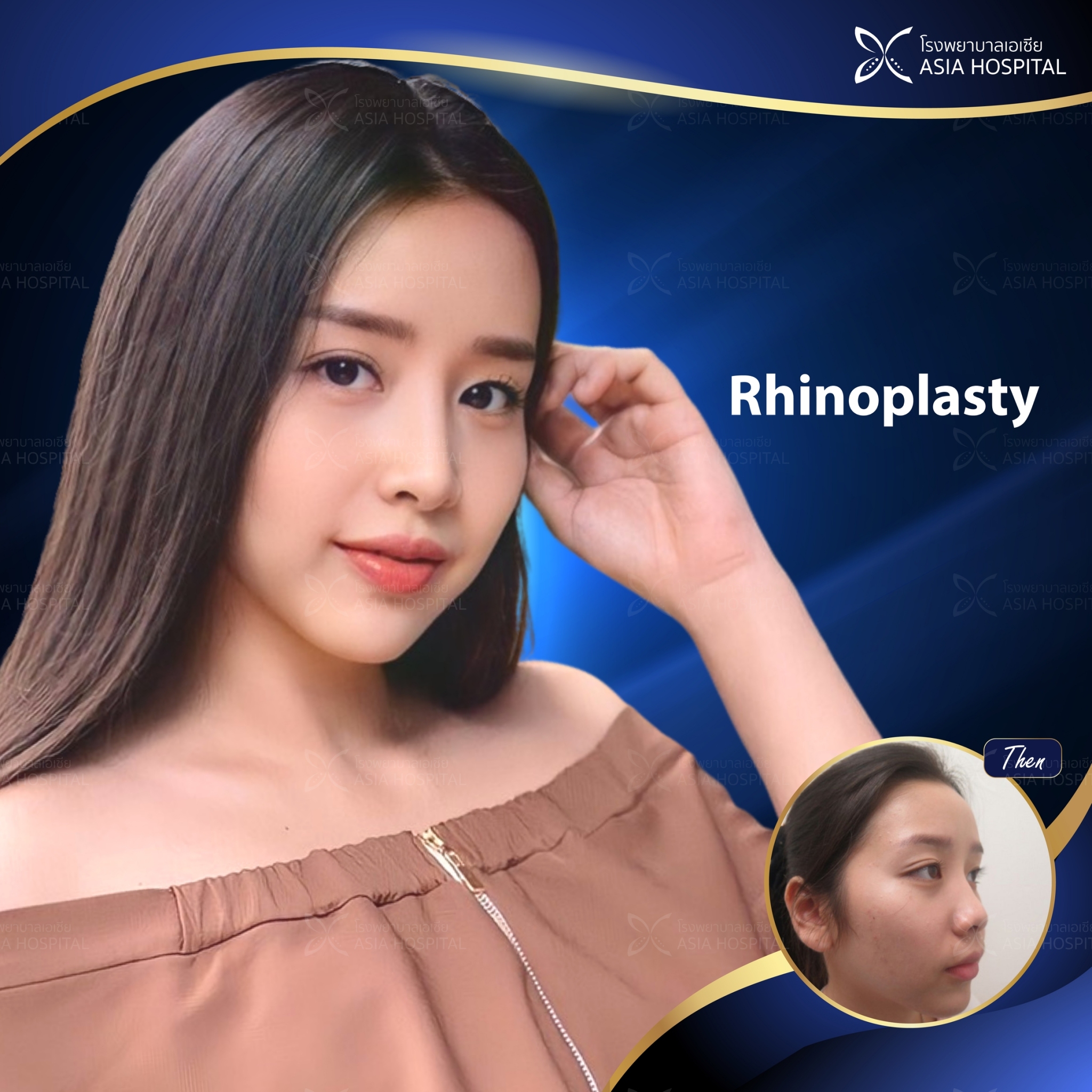 rhinoplasty-thailand