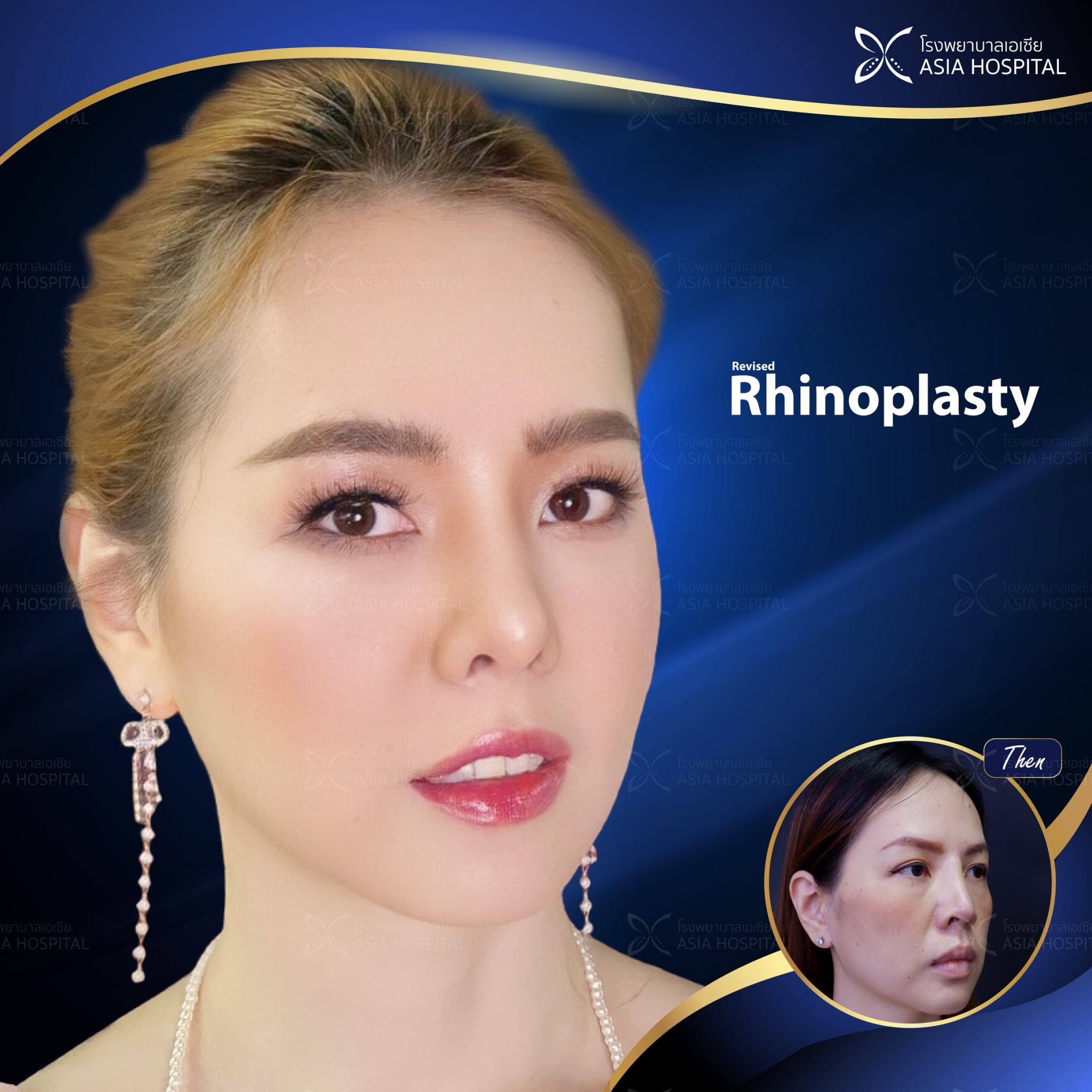 rhinoplasty-thailand