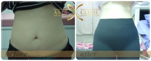 thailand liposuction