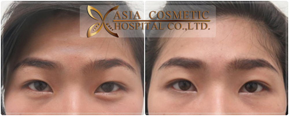 Double Eyelid Surgery