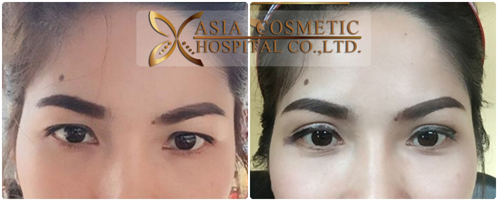 Double Eyelid Surgery