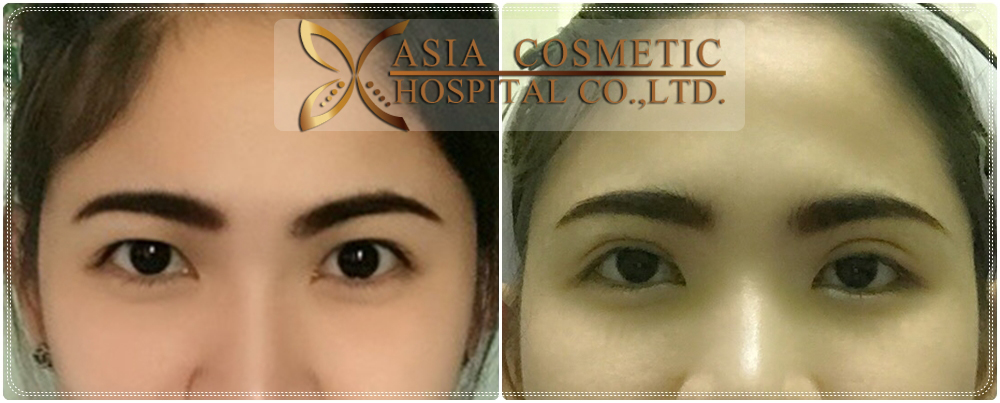 Double Eyelid Surgery