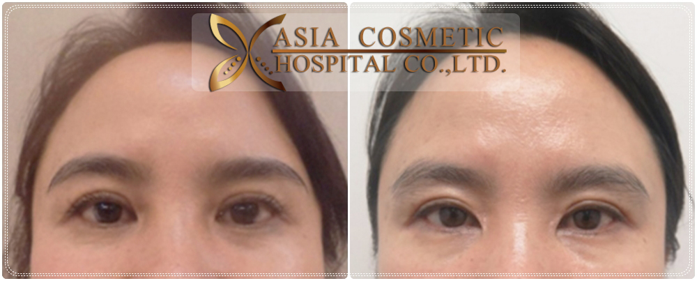 Double Eyelid Surgery