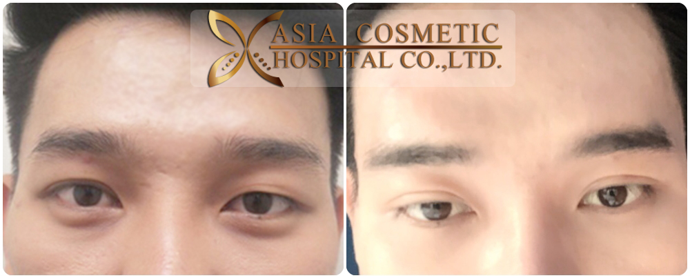 Double Eyelid Surgery