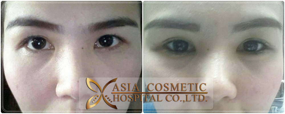 Double Eyelid Surgery