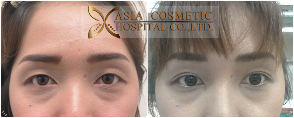 Double Eyelid Surgery