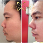 Male Nose Surgery