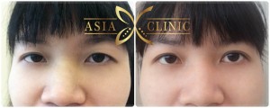 Upper Eyelid Surgery