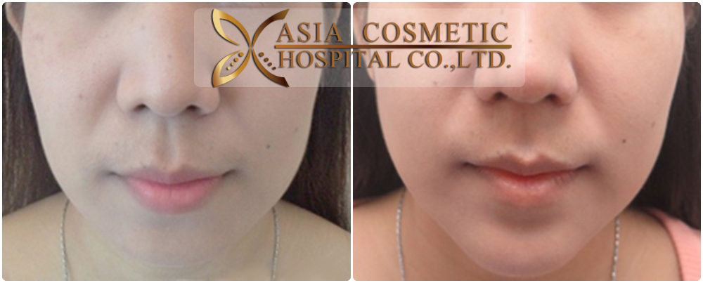 chin implants before after