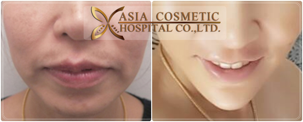 chin implants before after