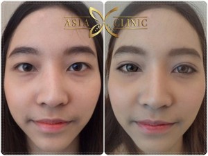 eyelid surgery