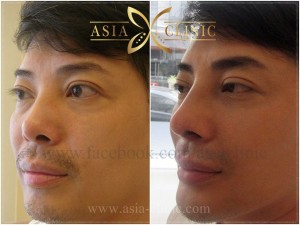 Chin Augmentation