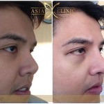 male rhinoplasty - nose surgery