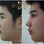 nose surgery male