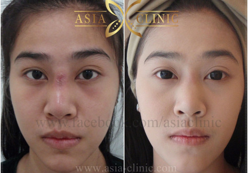 Scar Removal Surgery Before and After