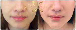 thailand chin augmentation