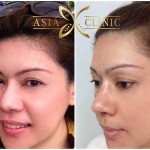 alar reduction surgery - revised nose augmentation