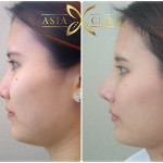 revised nose augmentation