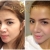 Revision Rhinoplasty Before & After – Thailand