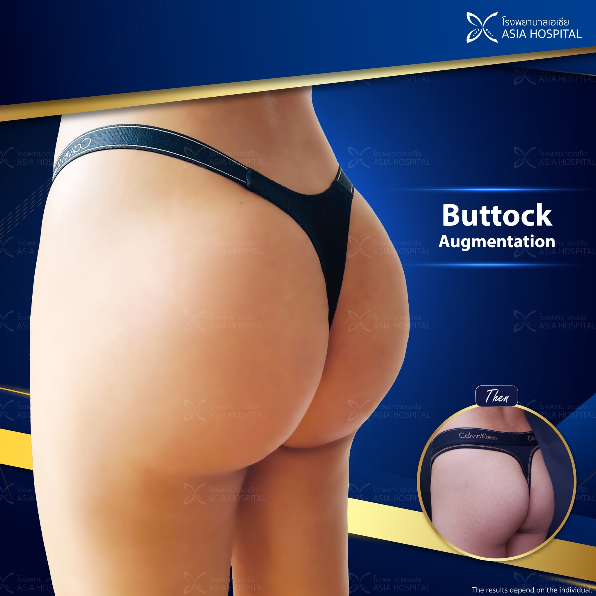 Buttock-augmentation-thailand