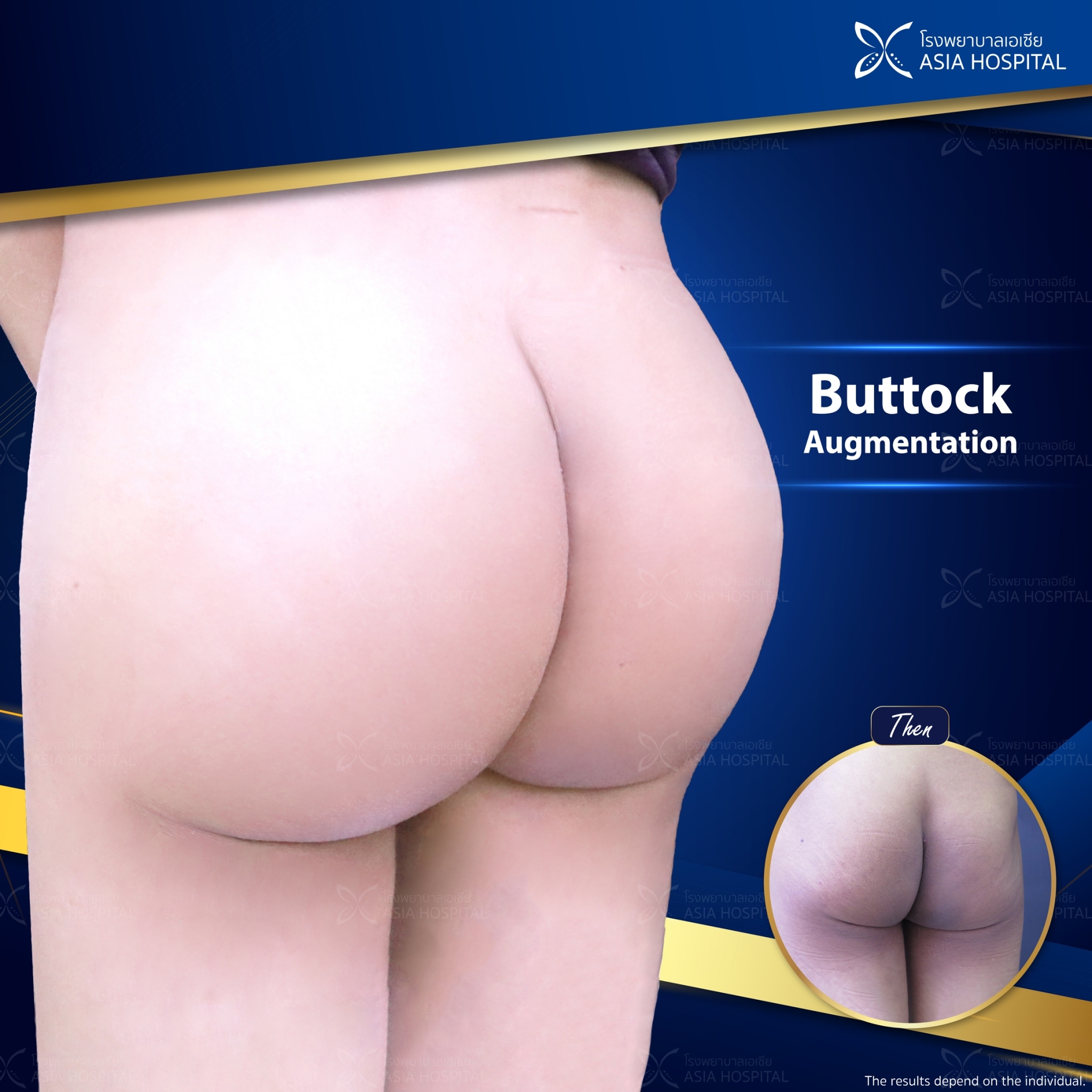 Buttock-augmentation-thailand
