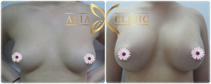 breast augmentation thailand