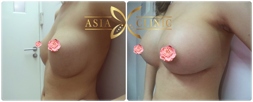 Asian Breast Enlargement 87