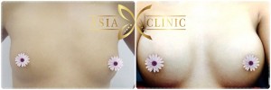 asiacosmeticthailand - breast augmentation thailand