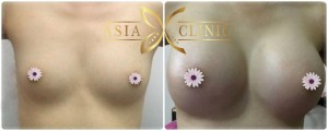 Breast implants, Augmentation at Asia Cosmetic Hospital