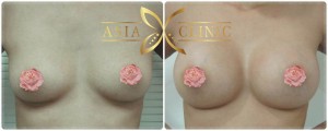 breast augmentation thailand