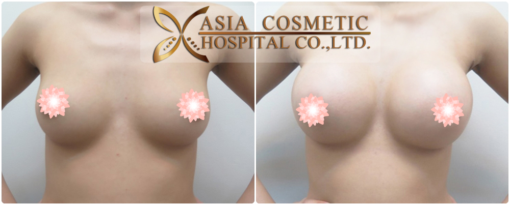 Breast Augmentation Before After