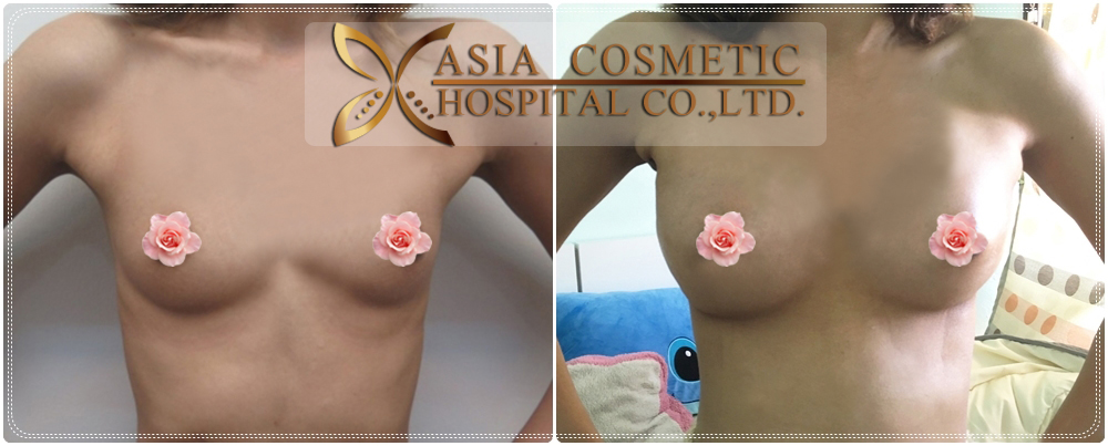 Breast Augmentation Before After