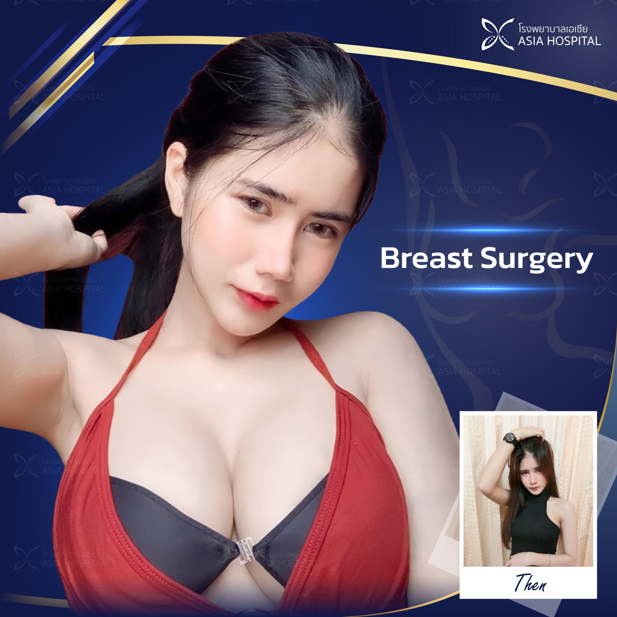Breast-augmentation