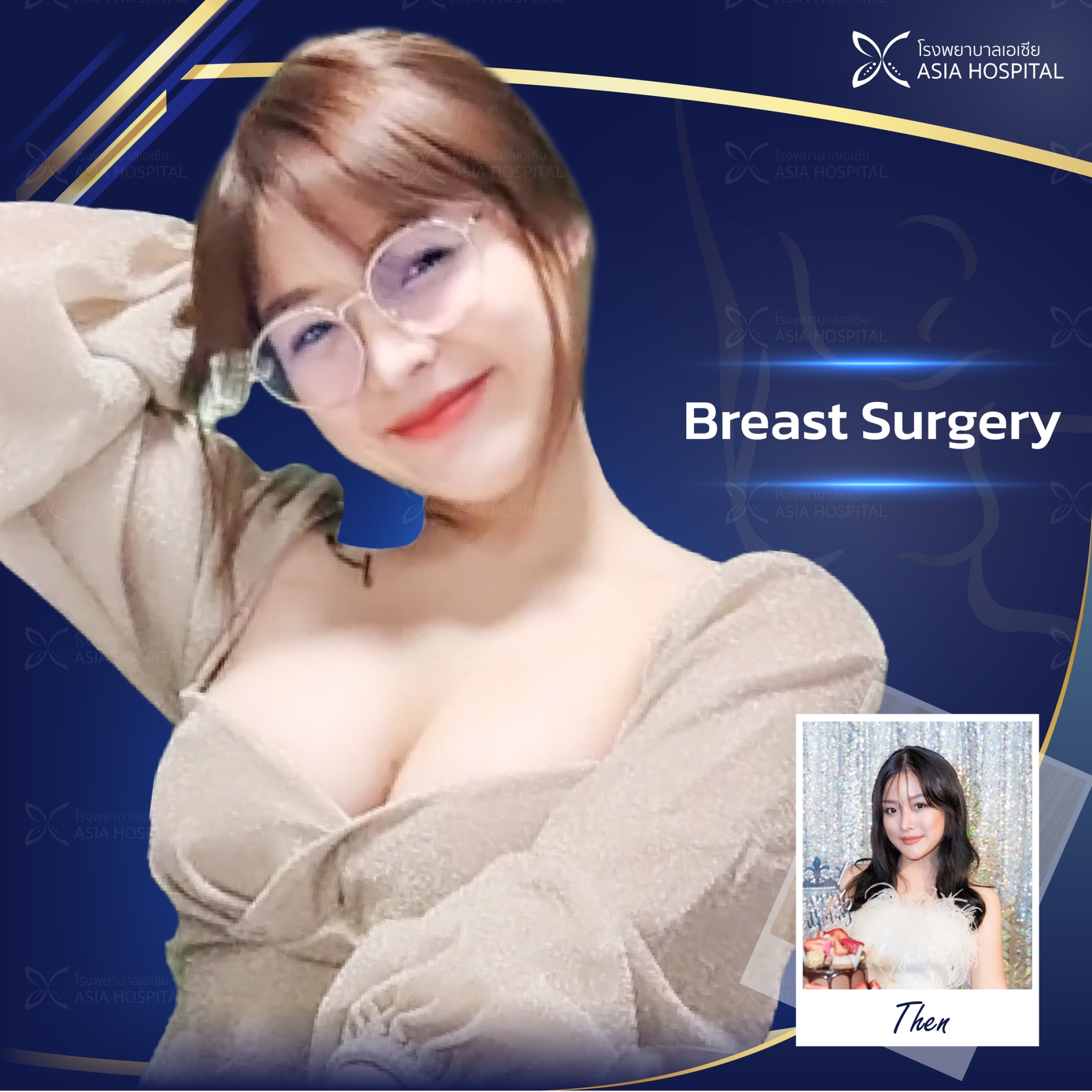 Breast-Augmentation-thailand