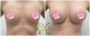 before after breast augmentation in thailand