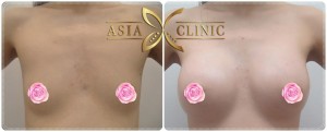 before after breast augmentation surgery thailand